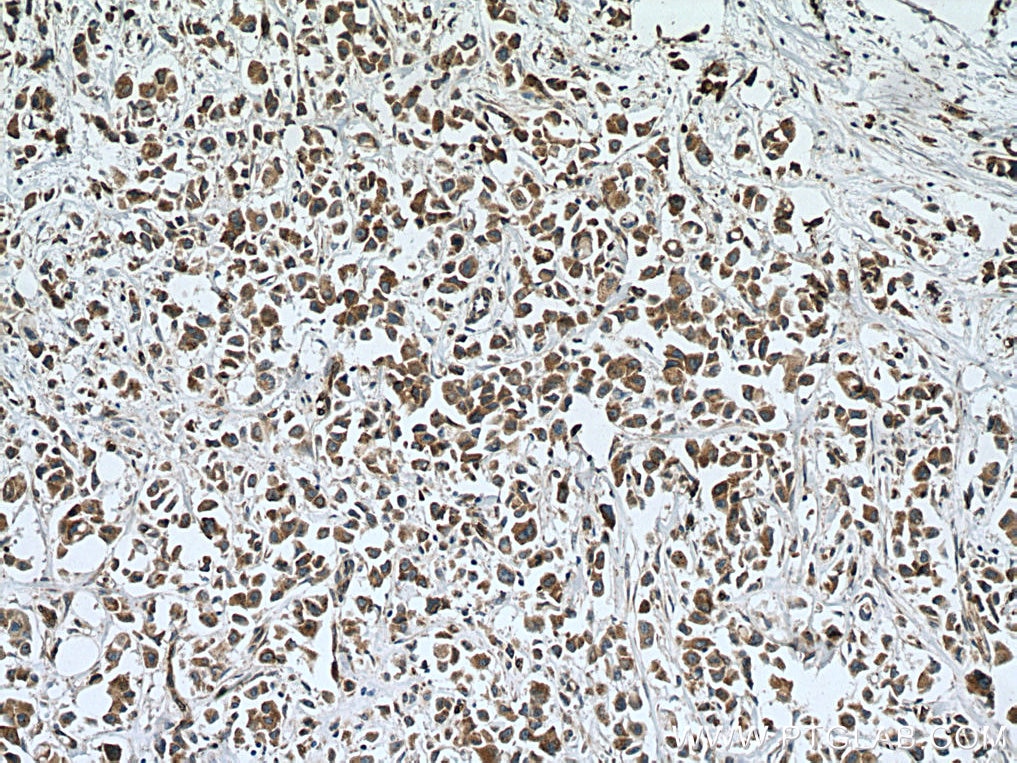 Immunohistochemistry (IHC) staining of human breast cancer tissue using SLC27A3 Polyclonal antibody (12943-1-AP)