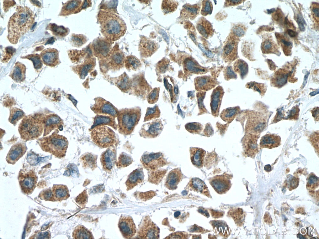 Immunohistochemistry (IHC) staining of human breast cancer tissue using SLC27A3 Polyclonal antibody (12943-1-AP)