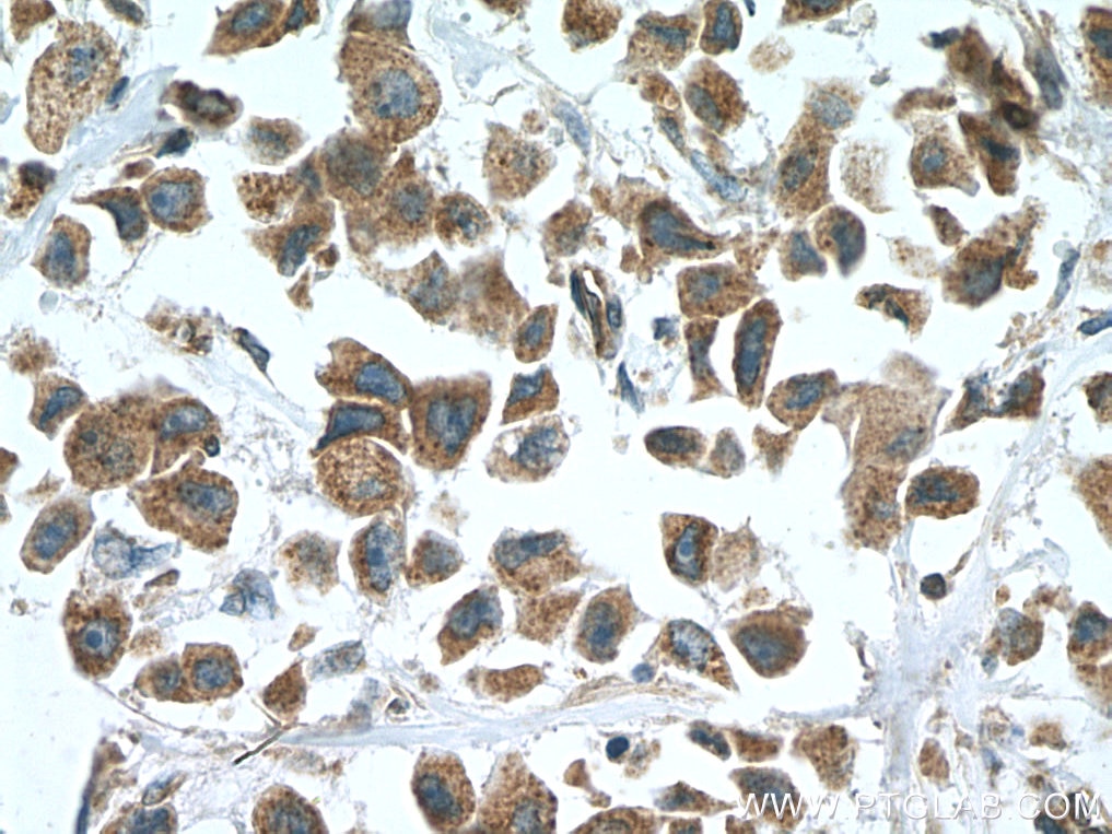 IHC staining of human breast cancer using 12943-1-AP