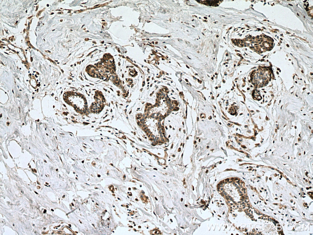 Immunohistochemistry (IHC) staining of human breast cancer tissue using SLC27A3 Polyclonal antibody (12943-1-AP)