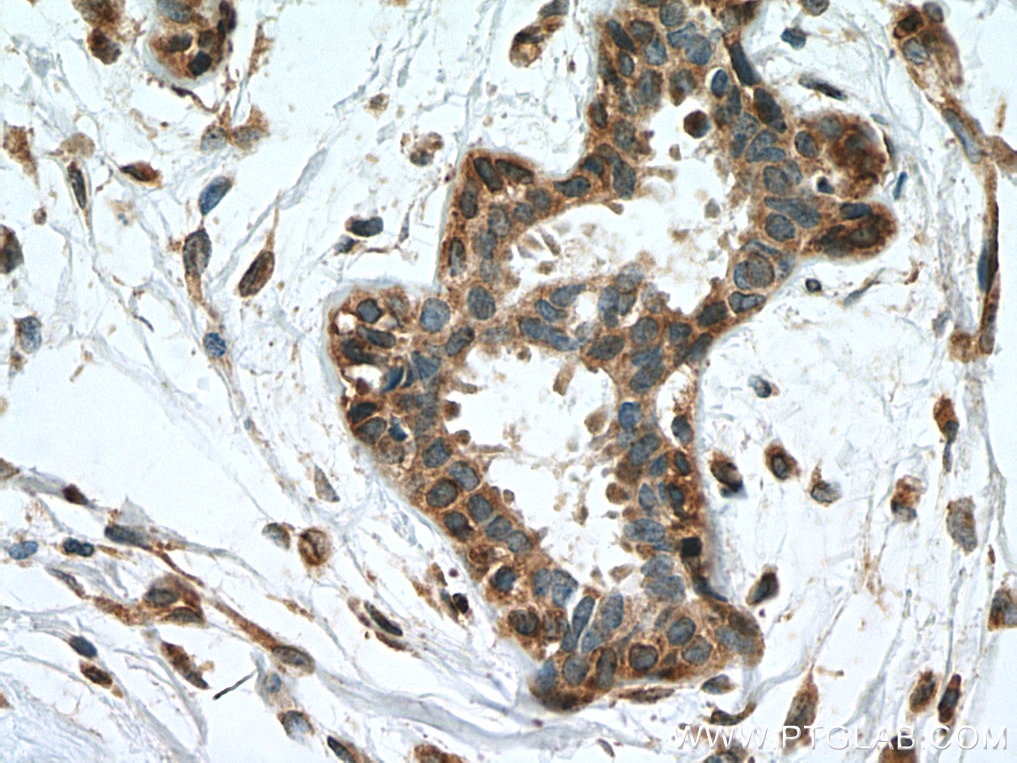 IHC staining of human breast cancer using 12943-1-AP