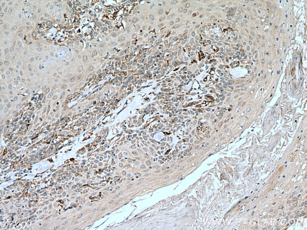 Immunohistochemistry (IHC) staining of human skin cancer tissue using SLC27A3 Polyclonal antibody (12943-1-AP)