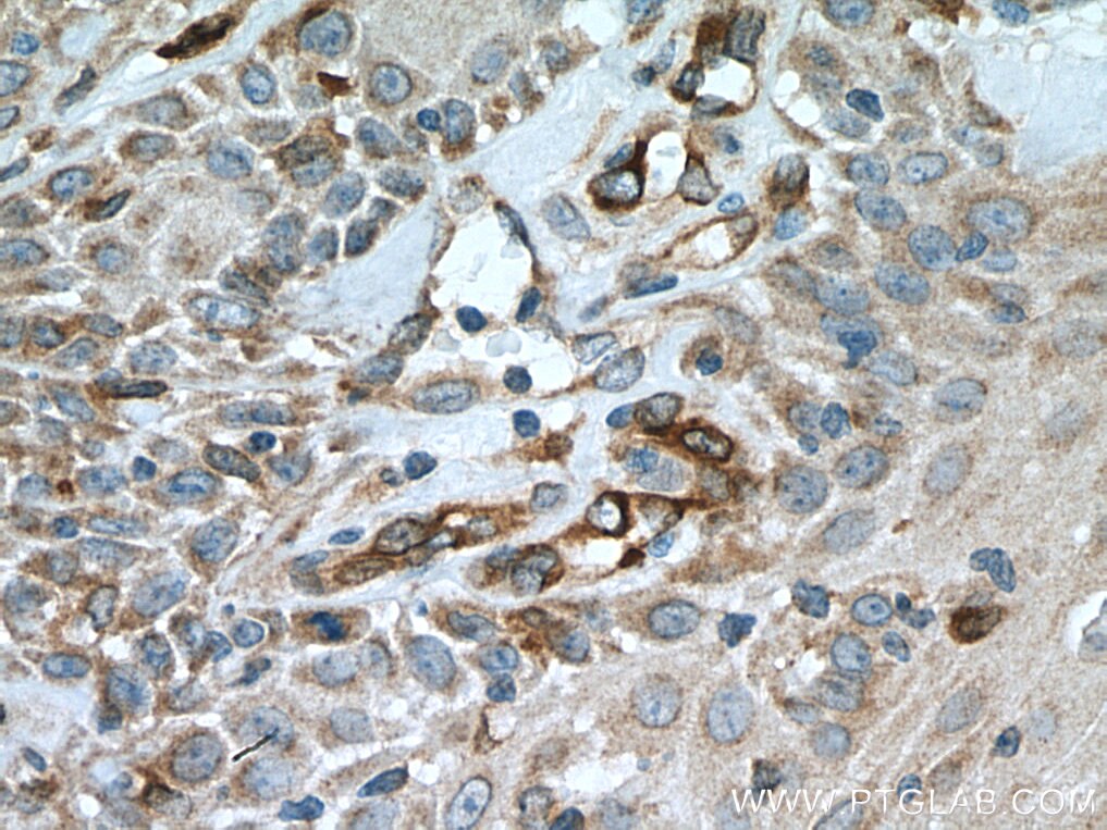 Immunohistochemistry (IHC) staining of human skin cancer tissue using SLC27A3 Polyclonal antibody (12943-1-AP)