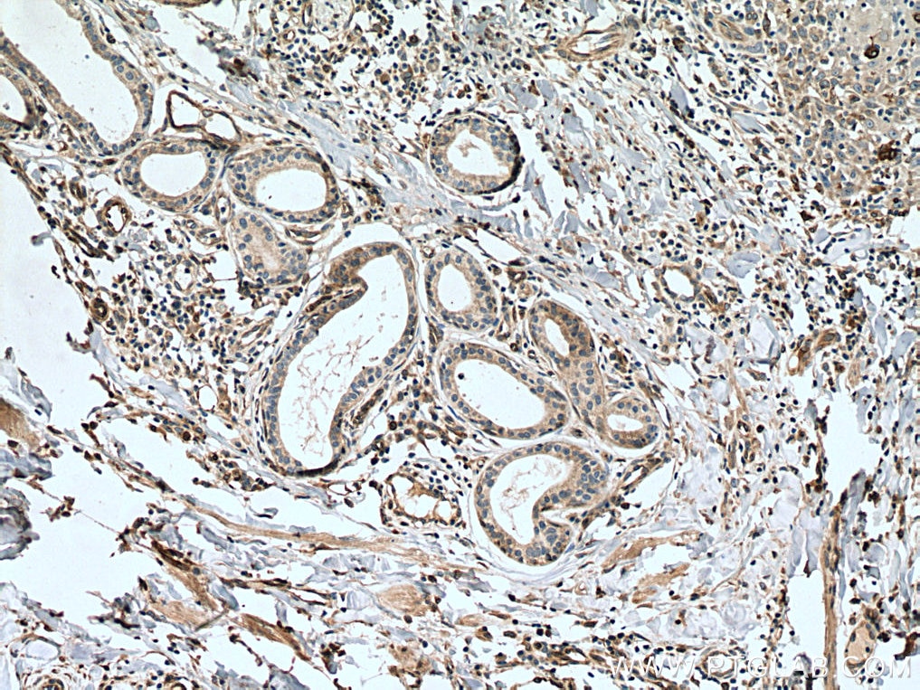 Immunohistochemistry (IHC) staining of human skin cancer tissue using SLC27A3 Polyclonal antibody (12943-1-AP)