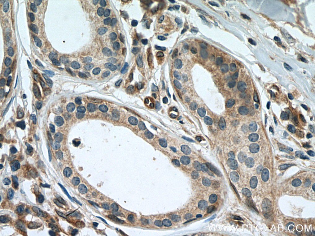 Immunohistochemistry (IHC) staining of human skin cancer tissue using SLC27A3 Polyclonal antibody (12943-1-AP)
