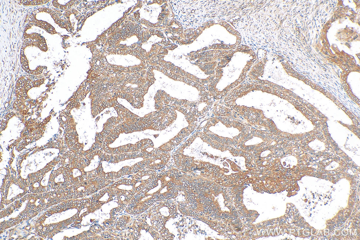 Immunohistochemistry (IHC) staining of human ovary tumor tissue using FATP4 Polyclonal antibody (11013-1-AP)