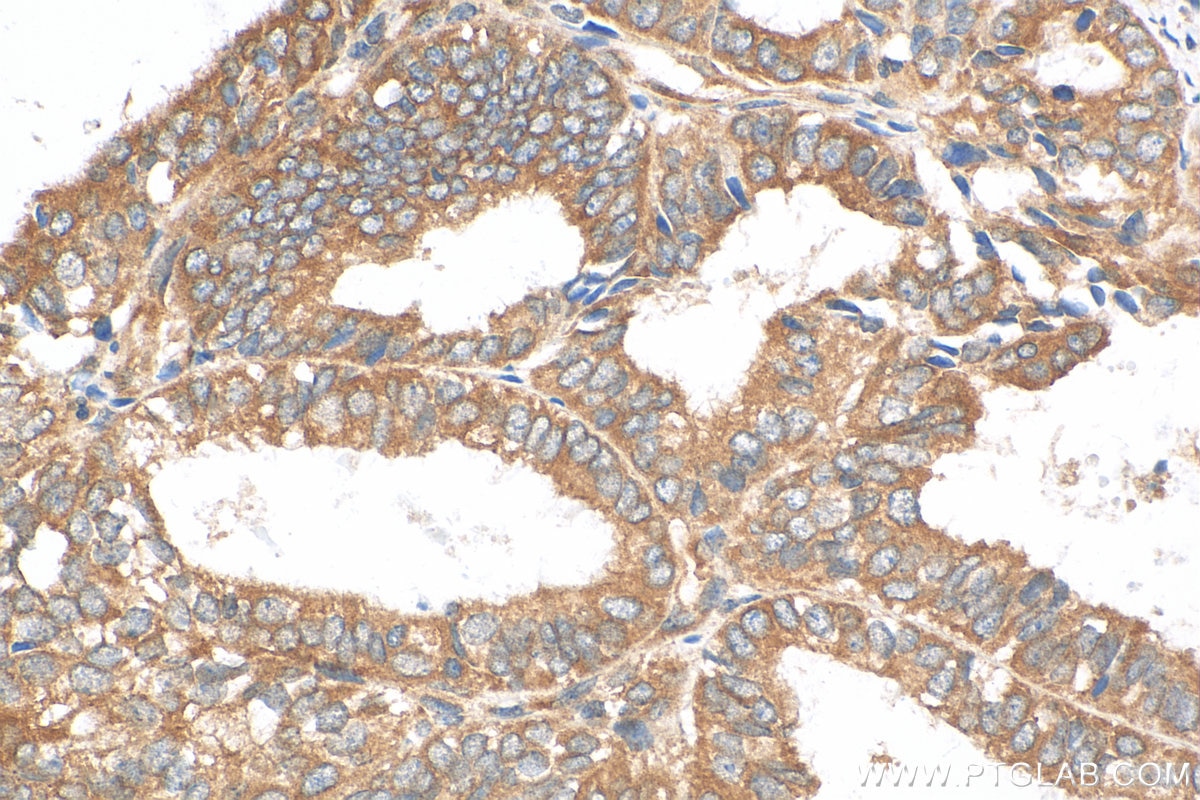 Immunohistochemistry (IHC) staining of human ovary tumor tissue using FATP4 Polyclonal antibody (11013-1-AP)