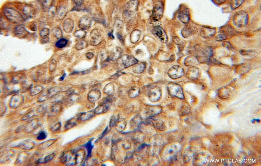 Immunohistochemistry (IHC) staining of human ovary tumor tissue using FATP4 Polyclonal antibody (11013-1-AP)