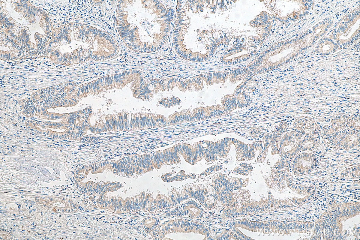 IHC staining of human pancreas cancer using 18182-1-AP