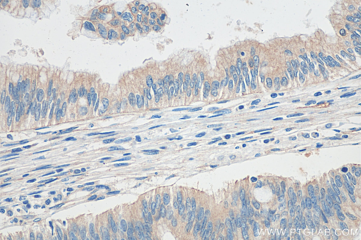 Immunohistochemistry (IHC) staining of human pancreas cancer tissue using SLC28A3 Polyclonal antibody (18182-1-AP)
