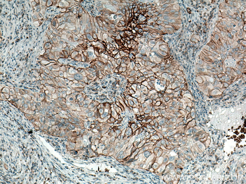 Immunohistochemistry (IHC) staining of human lung cancer tissue using GLUT1 Polyclonal antibody (21829-1-AP)