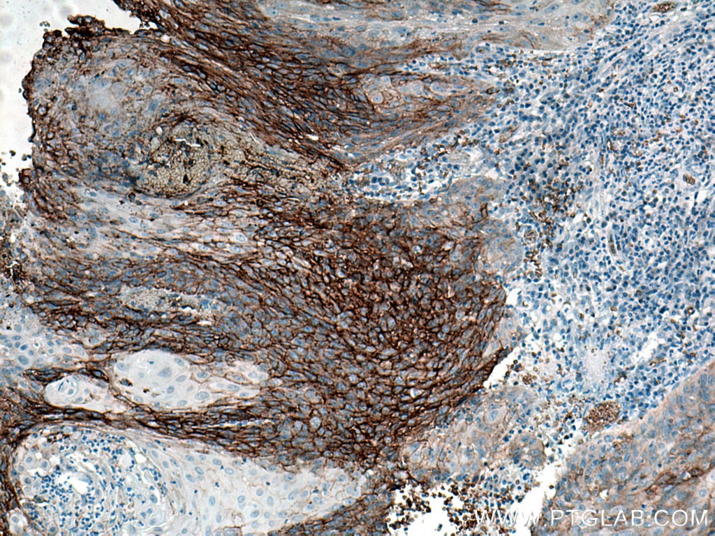 Immunohistochemistry (IHC) staining of human cervical cancer tissue using GLUT1 Polyclonal antibody (21829-1-AP)