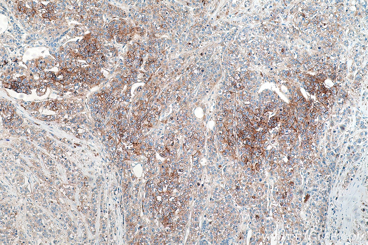 Immunohistochemistry (IHC) staining of human breast cancer tissue using GLUT1 Polyclonal antibody (21829-1-AP)