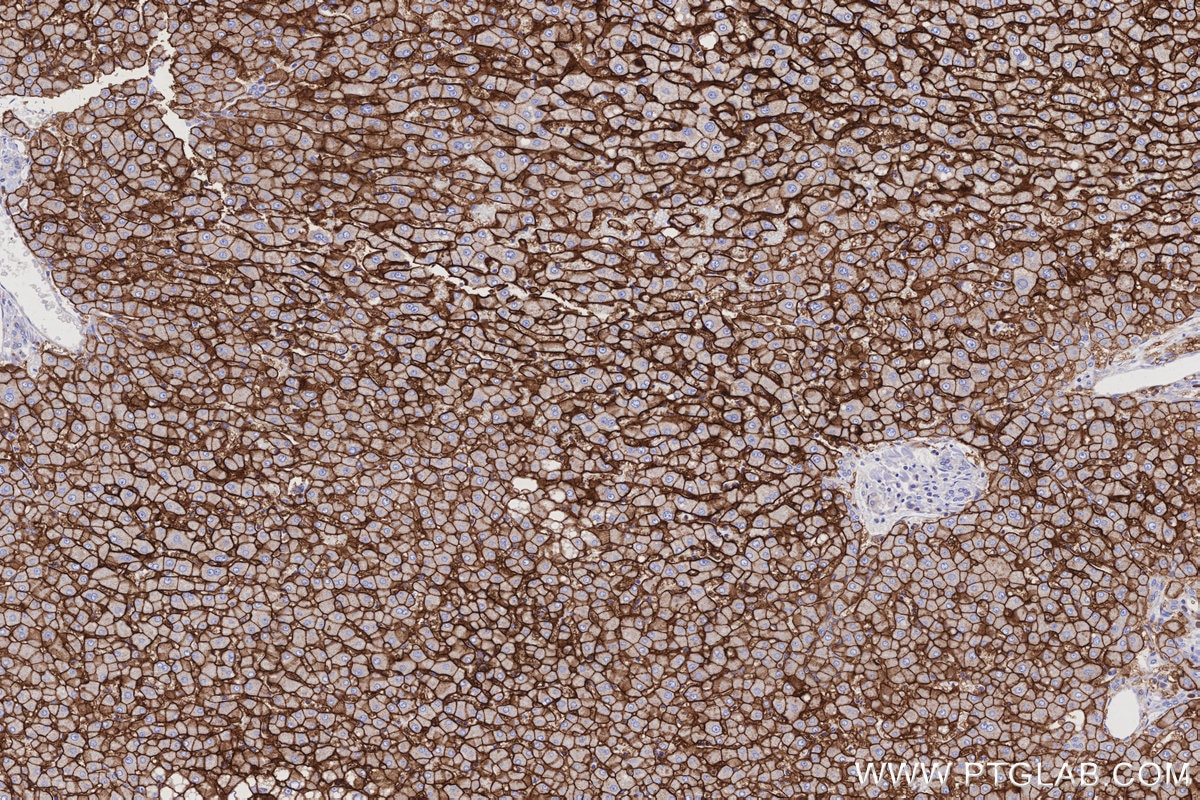 Immunohistochemistry (IHC) staining of human hepatocirrhosis tissue using GLUT2 Polyclonal antibody (20436-1-AP)