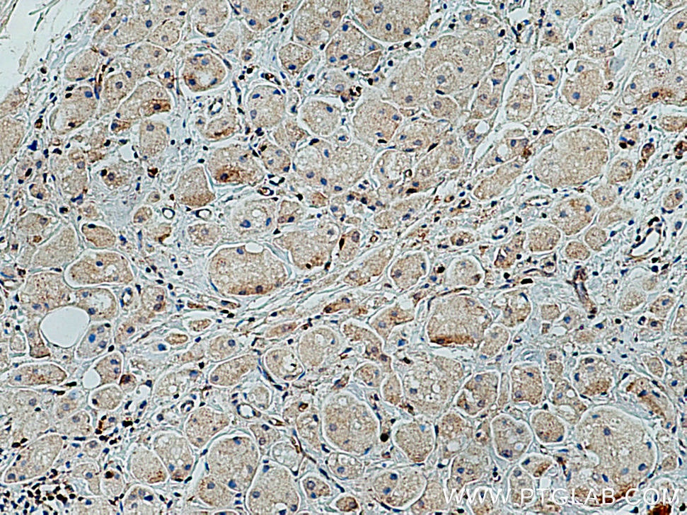 Immunohistochemistry (IHC) staining of human breast cancer tissue using GLUT3 Polyclonal antibody (20403-1-AP)