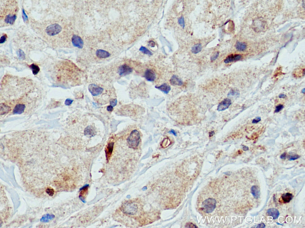 Immunohistochemistry (IHC) staining of human breast cancer tissue using GLUT3 Polyclonal antibody (20403-1-AP)