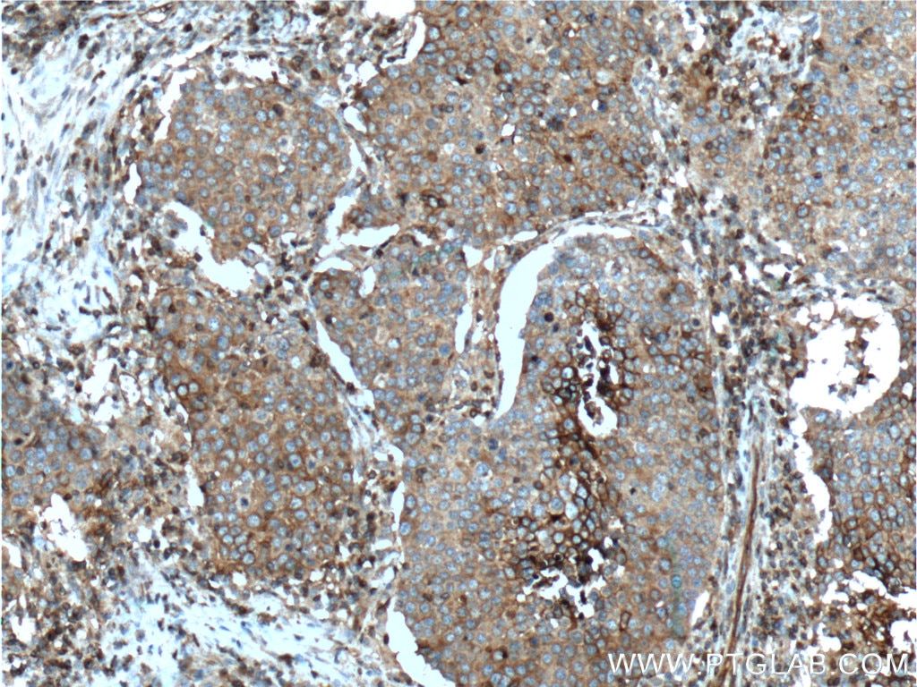 Immunohistochemistry (IHC) staining of human lung cancer tissue using GLUT3 Polyclonal antibody (20403-1-AP)