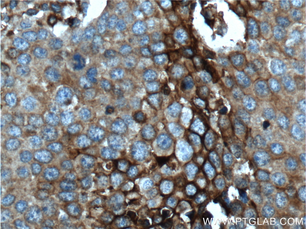 Immunohistochemistry (IHC) staining of human lung cancer tissue using GLUT3 Polyclonal antibody (20403-1-AP)