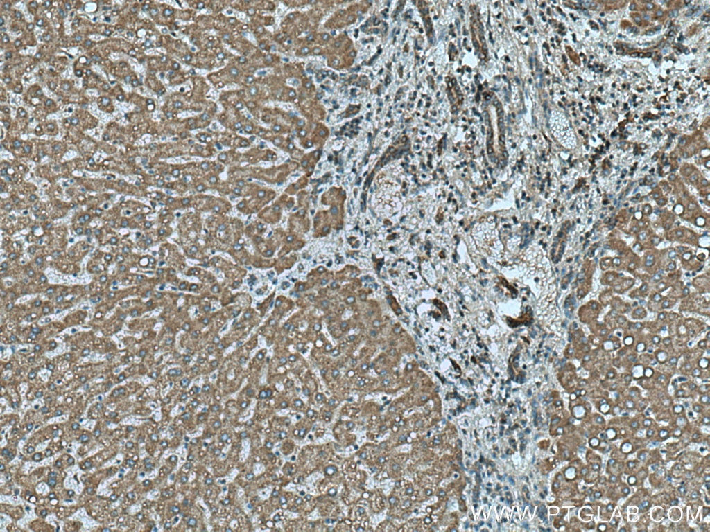 Immunohistochemistry (IHC) staining of human hepatocirrhosis tissue using SLC2A9 Polyclonal antibody (26486-1-AP)