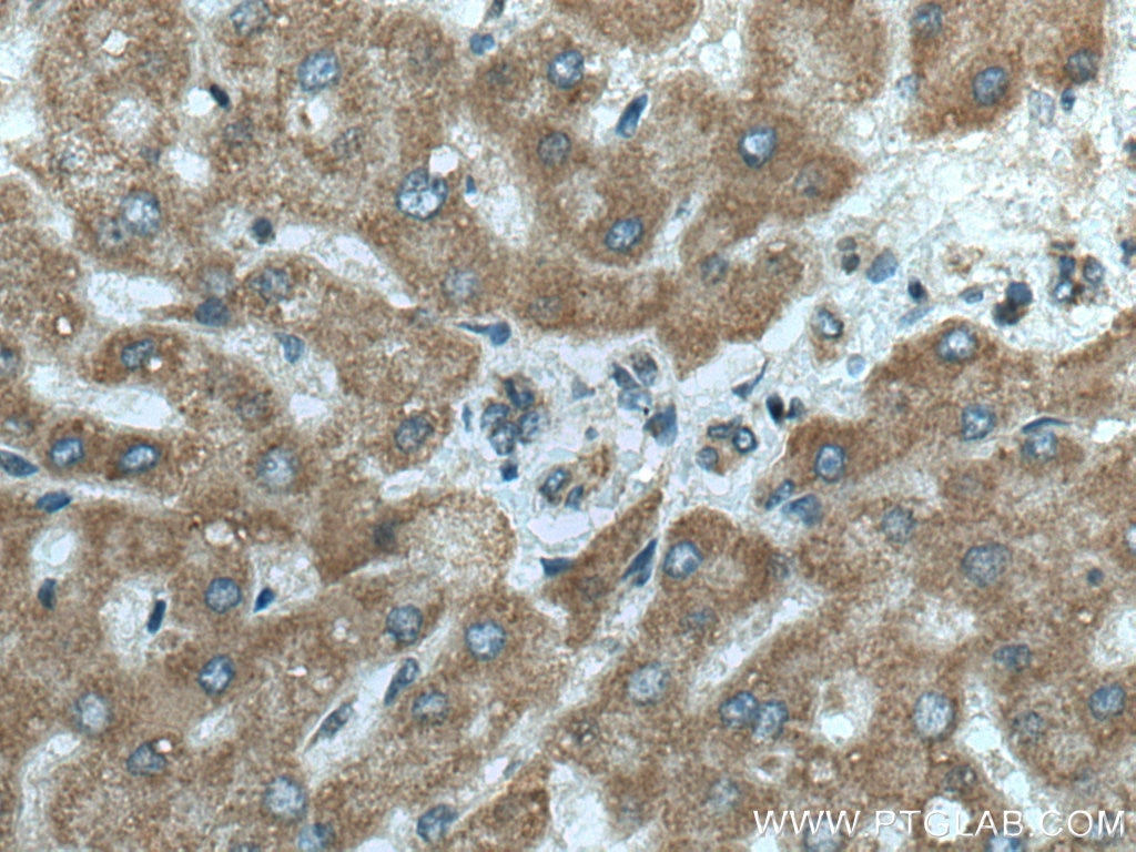 Immunohistochemistry (IHC) staining of human hepatocirrhosis tissue using SLC2A9 Polyclonal antibody (26486-1-AP)