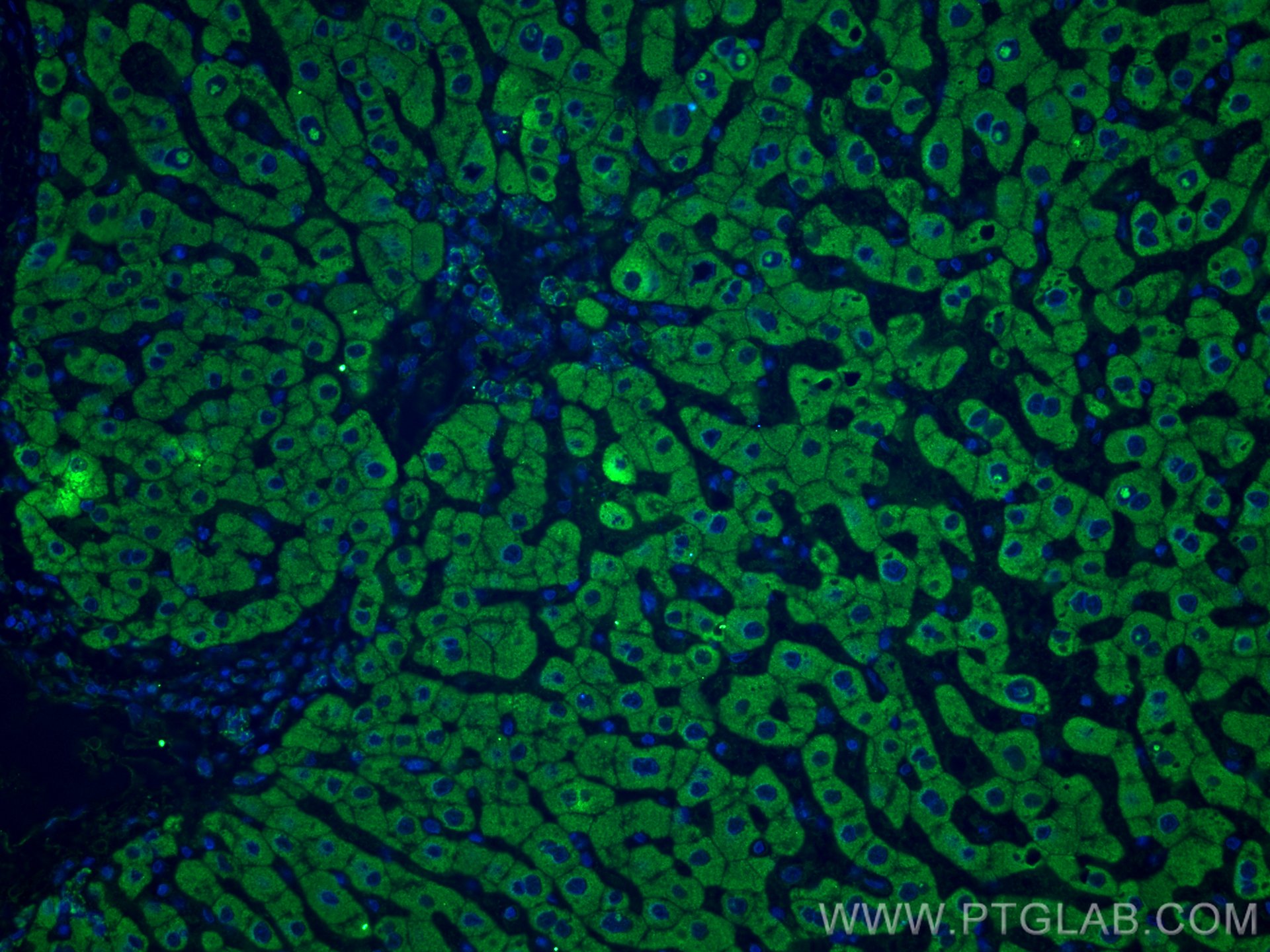 IF Staining of human hepatocirrhosis using 67530-1-Ig