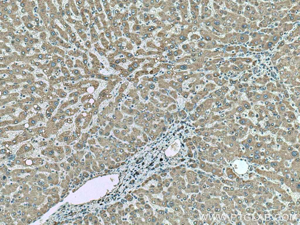 Immunohistochemistry (IHC) staining of human hepatocirrhosis tissue using SLC2A9 Monoclonal antibody (67530-1-Ig)