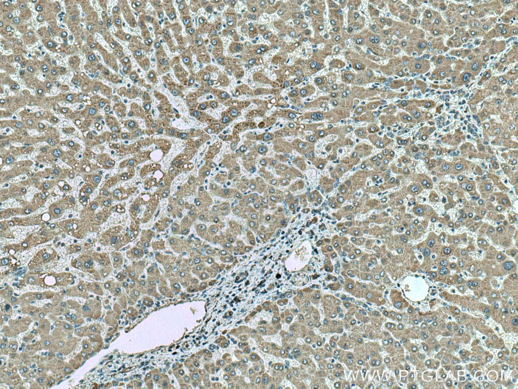 Immunohistochemistry (IHC) staining of human hepatocirrhosis tissue using SLC2A9 Monoclonal antibody (67530-1-Ig)