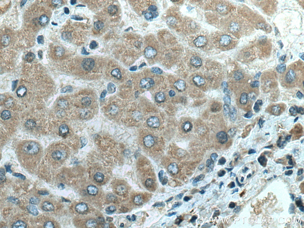 Immunohistochemistry (IHC) staining of human hepatocirrhosis tissue using SLC2A9 Monoclonal antibody (67530-1-Ig)