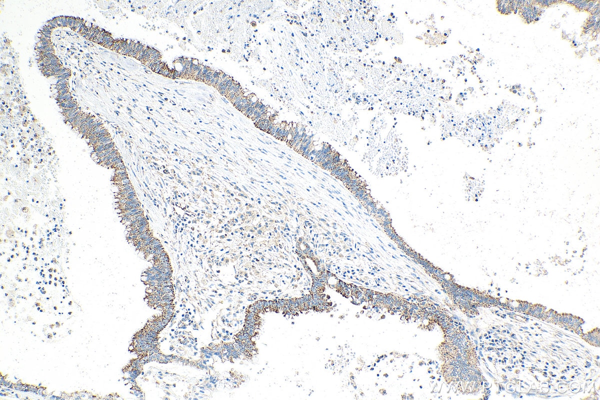 Immunohistochemistry (IHC) staining of human pancreas cancer tissue using SLC30A2 Monoclonal antibody (67993-1-Ig)