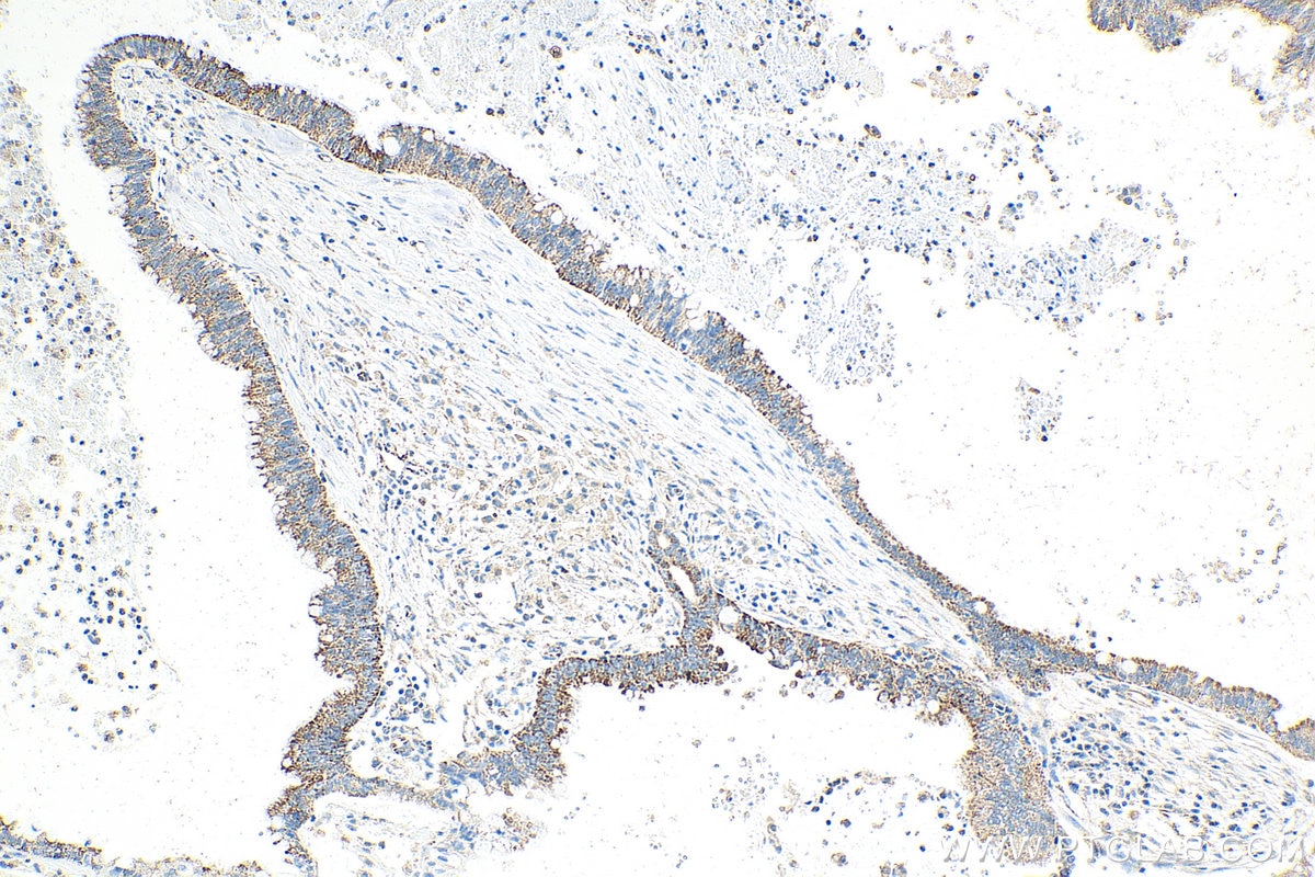 IHC staining of human pancreas cancer using 67993-1-Ig