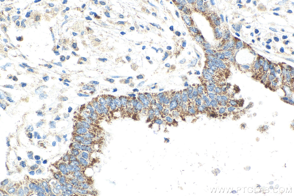 IHC staining of human pancreas cancer using 67993-1-Ig