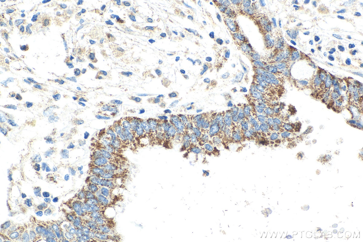 Immunohistochemistry (IHC) staining of human pancreas cancer tissue using SLC30A2 Monoclonal antibody (67993-1-Ig)