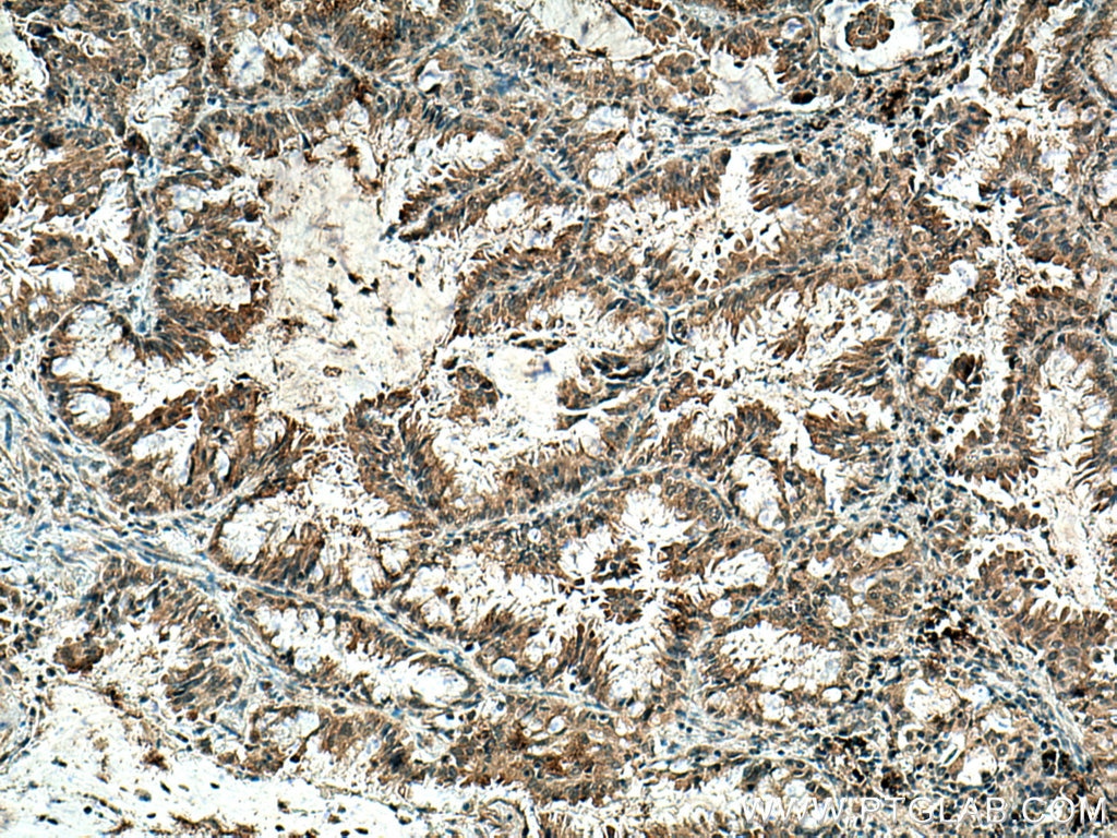 Immunohistochemistry (IHC) staining of human lung cancer tissue using ZnT7 Polyclonal antibody (13966-1-AP)
