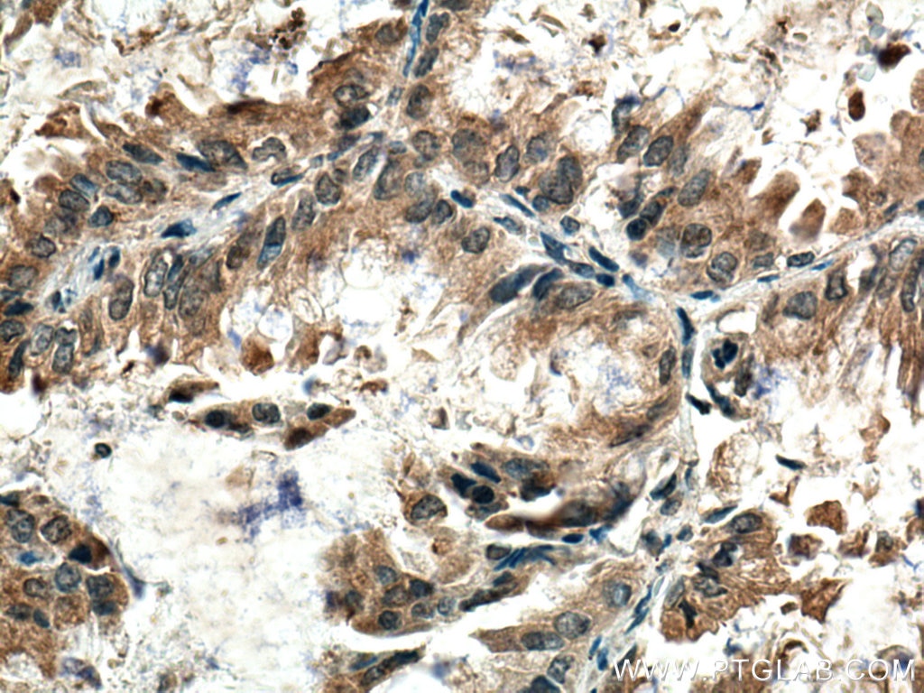 Immunohistochemistry (IHC) staining of human lung cancer tissue using ZnT7 Polyclonal antibody (13966-1-AP)