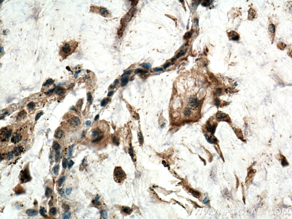 Immunohistochemistry (IHC) staining of human lung cancer tissue using ZnT7 Polyclonal antibody (13966-1-AP)