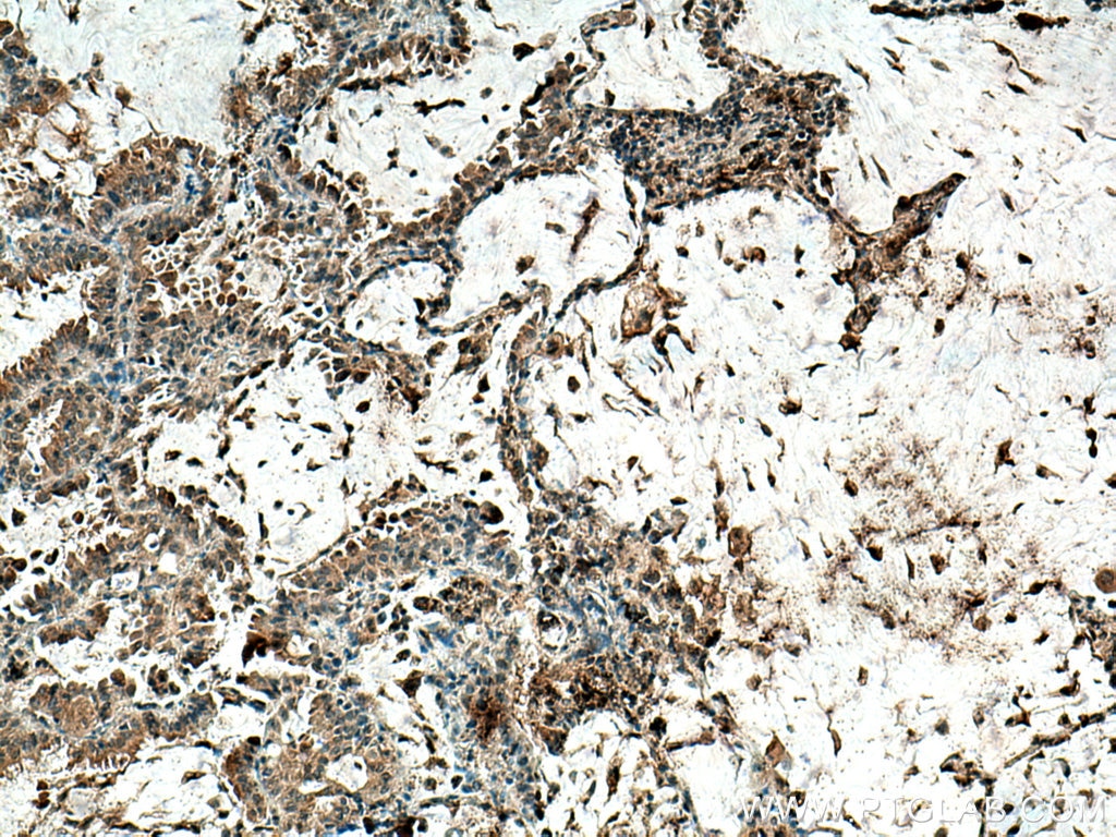 Immunohistochemistry (IHC) staining of human lung cancer tissue using ZnT7 Polyclonal antibody (13966-1-AP)