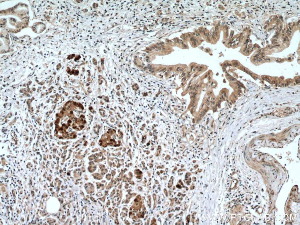 Immunohistochemistry (IHC) staining of human pancreas cancer tissue using SLC30A8/ZNT8-Specific Polyclonal antibody (16169-1-AP)