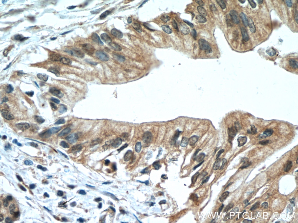 Immunohistochemistry (IHC) staining of human pancreas cancer tissue using SLC30A8/ZNT8-Specific Polyclonal antibody (16169-1-AP)