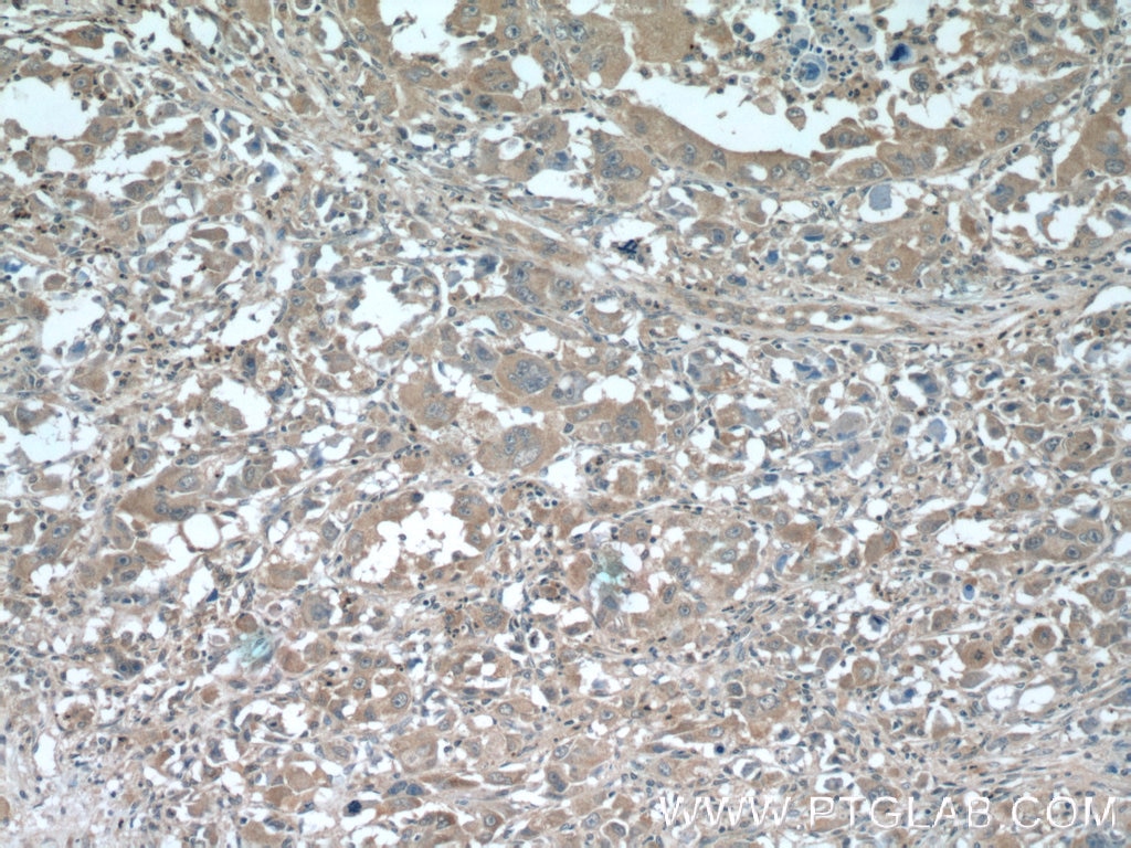 Immunohistochemistry (IHC) staining of human liver cancer tissue using SLC30A8/ZNT8-Specific Polyclonal antibody (16169-1-AP)