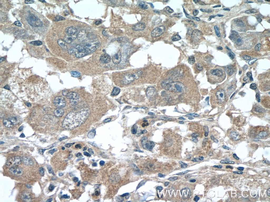 Immunohistochemistry (IHC) staining of human liver cancer tissue using SLC30A8/ZNT8-Specific Polyclonal antibody (16169-1-AP)