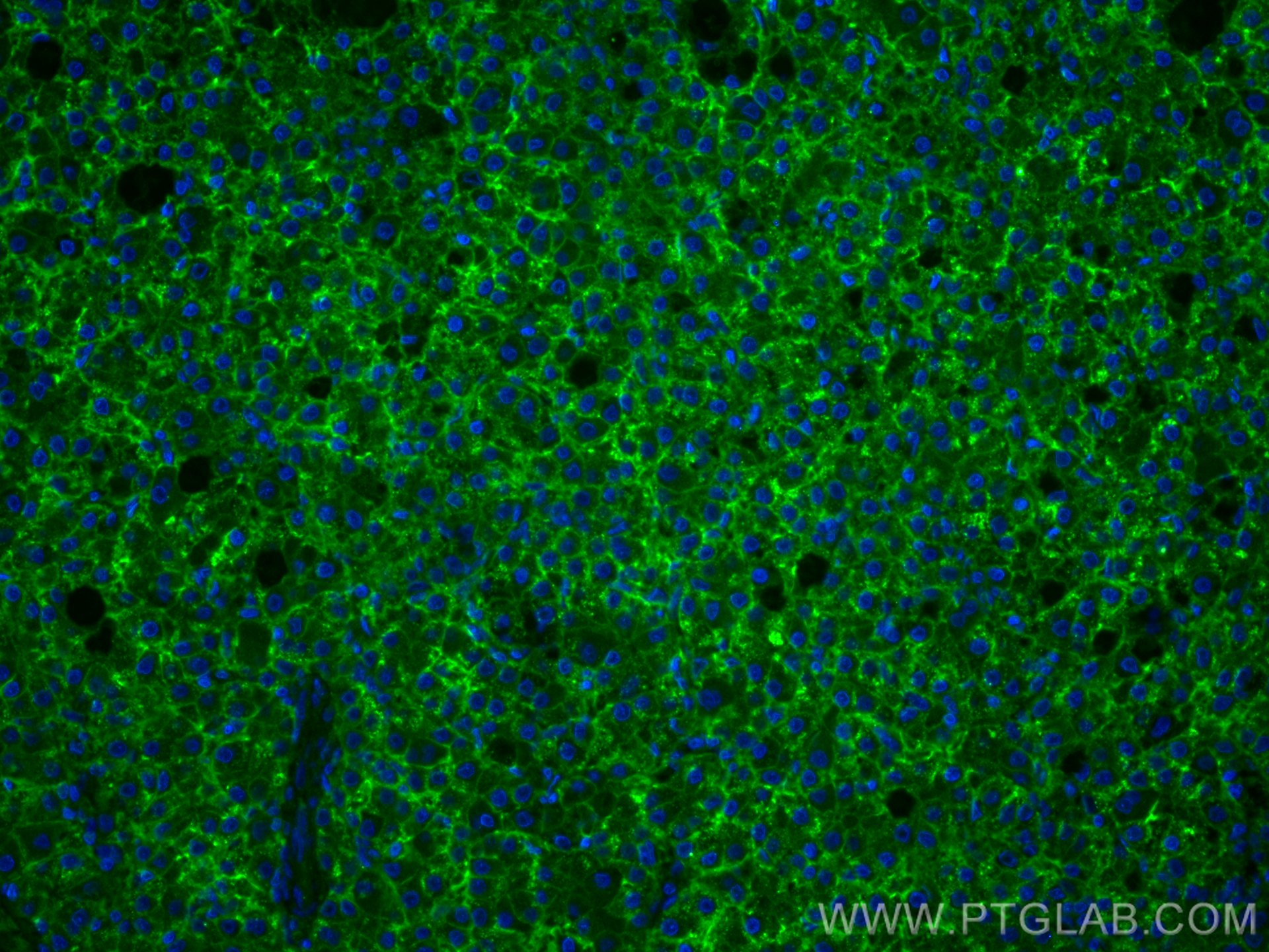 Immunofluorescence (IF) / fluorescent staining of human liver cancer tissue using SLC31A1 Polyclonal antibody (27499-1-AP)
