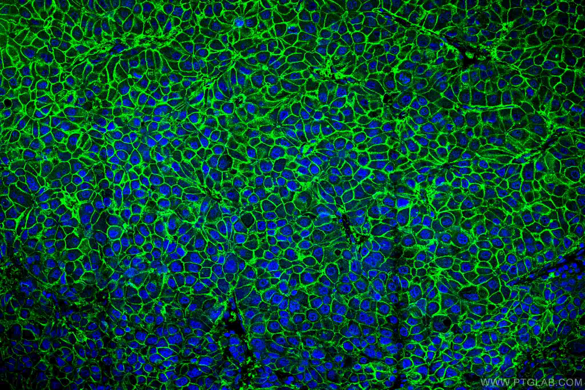 Immunofluorescence (IF) / fluorescent staining of human liver cancer tissue using SLC31A1 Monoclonal antibody (67221-1-Ig)