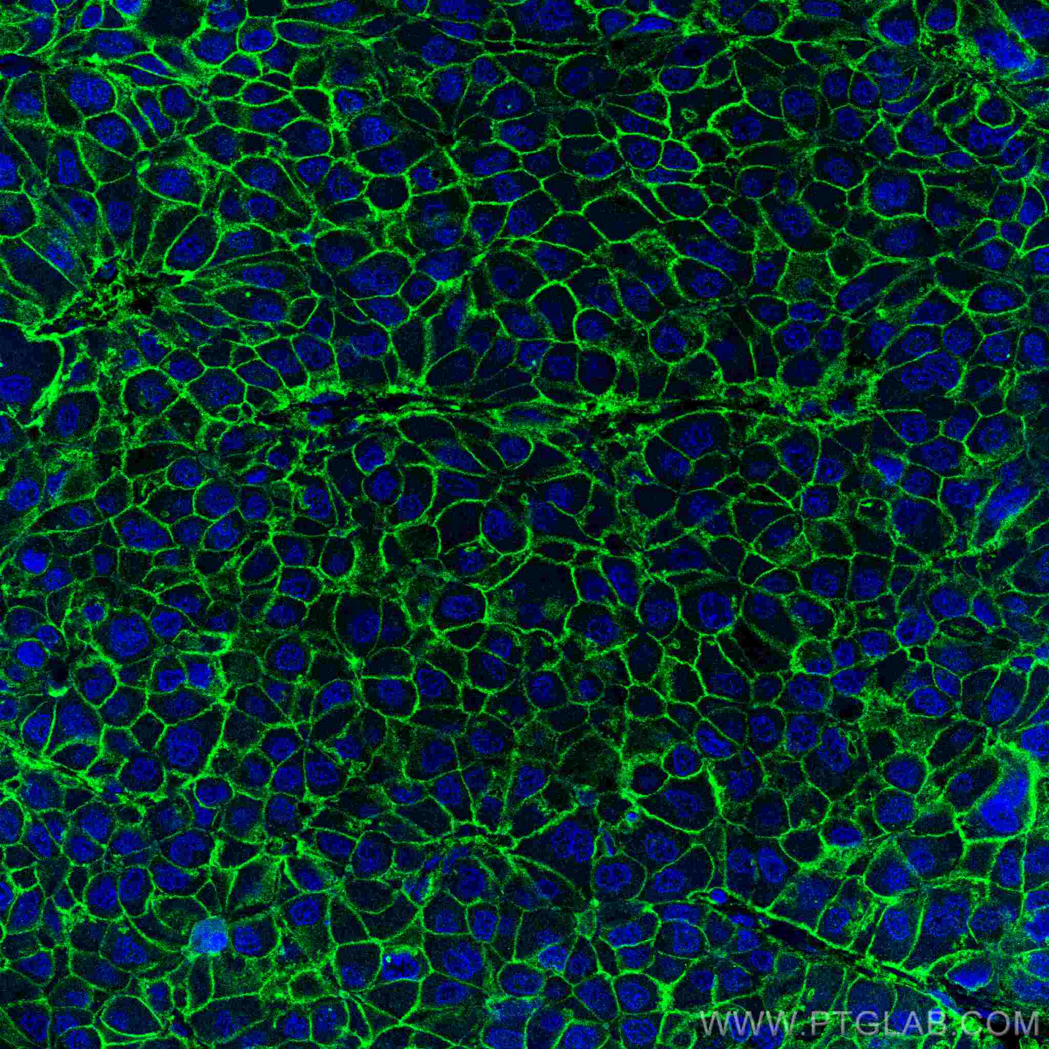 Immunofluorescence (IF) / fluorescent staining of human liver cancer tissue using SLC31A1 Monoclonal antibody (67221-1-Ig)