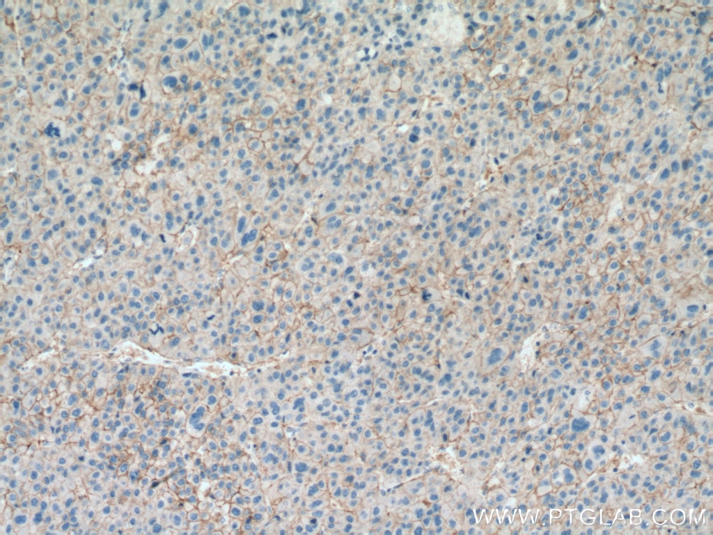 Immunohistochemistry (IHC) staining of human liver cancer tissue using SLC31A1 Monoclonal antibody (67221-1-Ig)