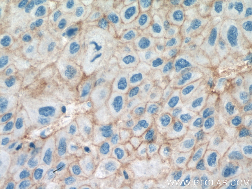 IHC staining of human liver cancer using 67221-1-Ig