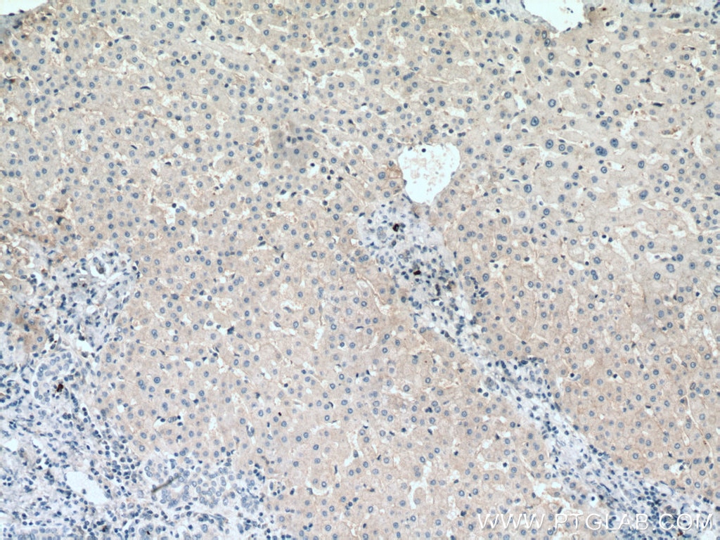 Immunohistochemistry (IHC) staining of human liver cancer tissue using SLC31A1 Monoclonal antibody (67221-1-Ig)