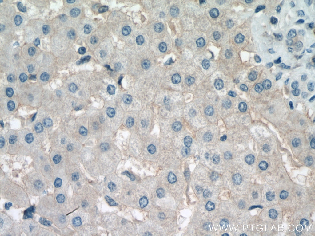 Immunohistochemistry (IHC) staining of human liver cancer tissue using SLC31A1 Monoclonal antibody (67221-1-Ig)