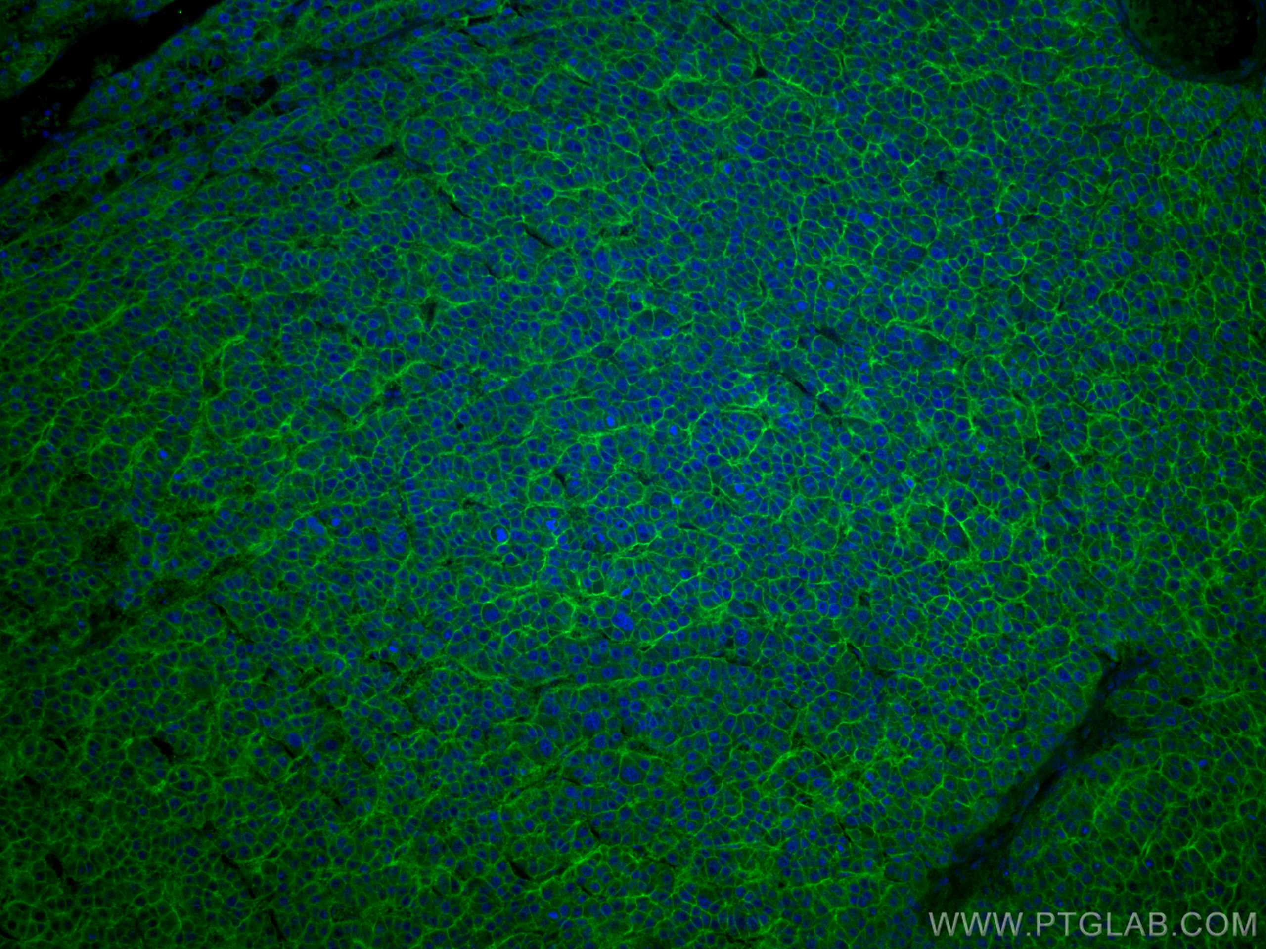 Immunofluorescence (IF) / fluorescent staining of human liver cancer tissue using CoraLite® Plus 488-conjugated SLC31A1 Monoclonal a (CL488-67221)