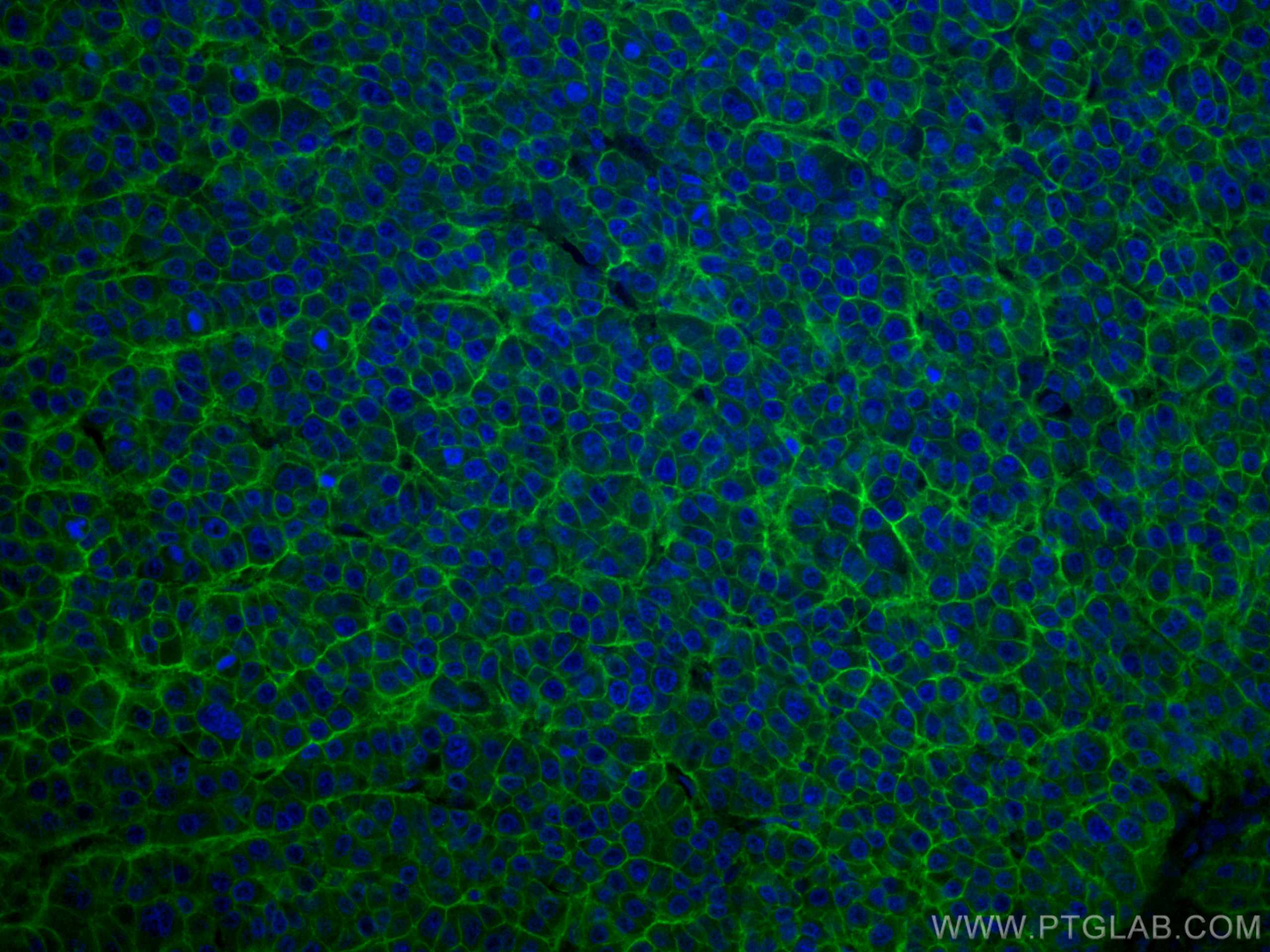 IF Staining of human liver cancer using CL488-67221