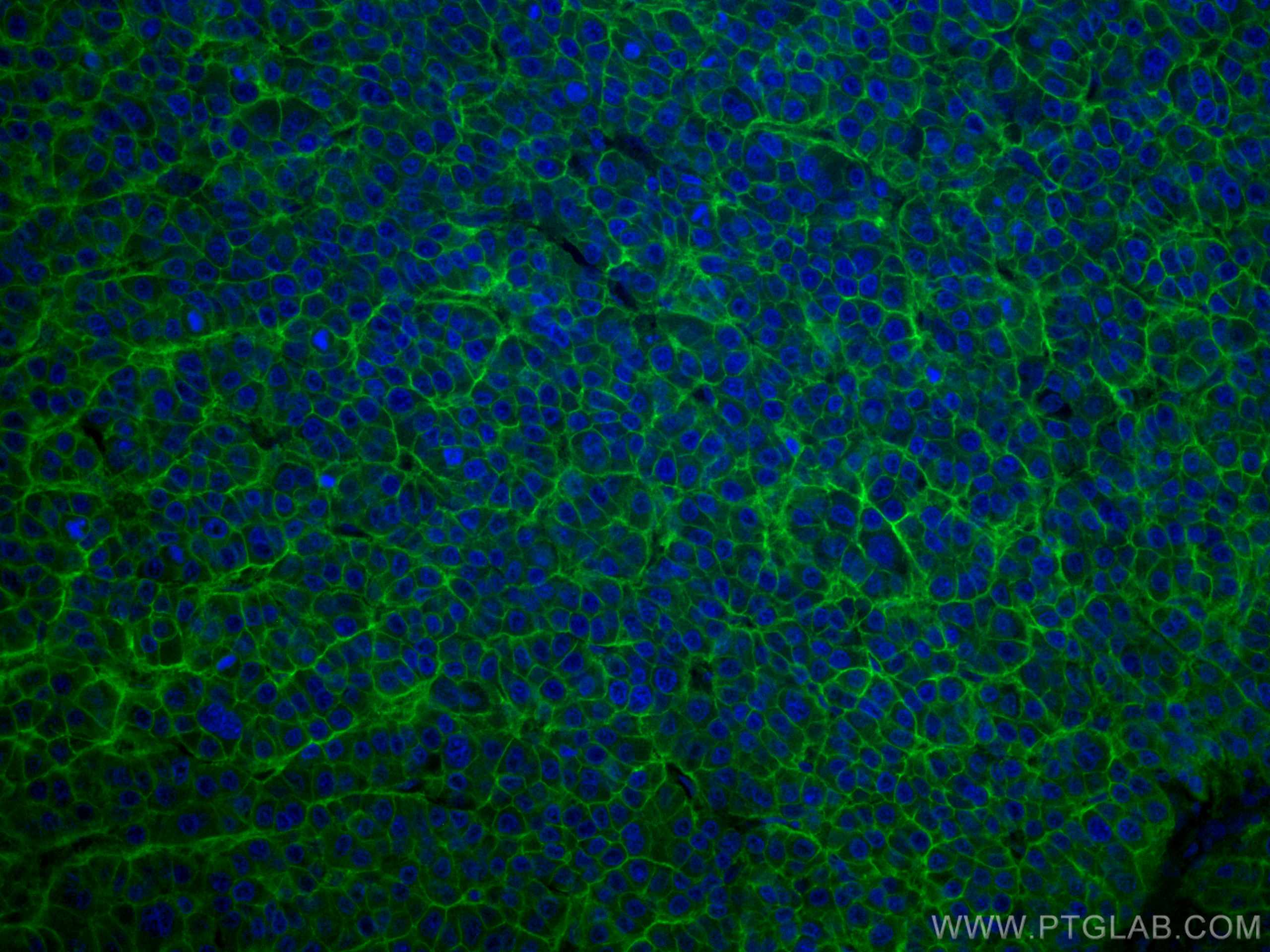 Immunofluorescence (IF) / fluorescent staining of human liver cancer tissue using CoraLite® Plus 488-conjugated SLC31A1 Monoclonal a (CL488-67221)